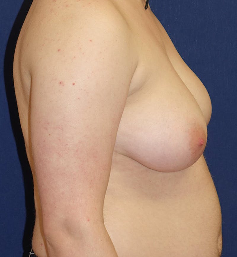 Masculinizing Surgery Before & After Gallery - Patient 333757 - Image 3