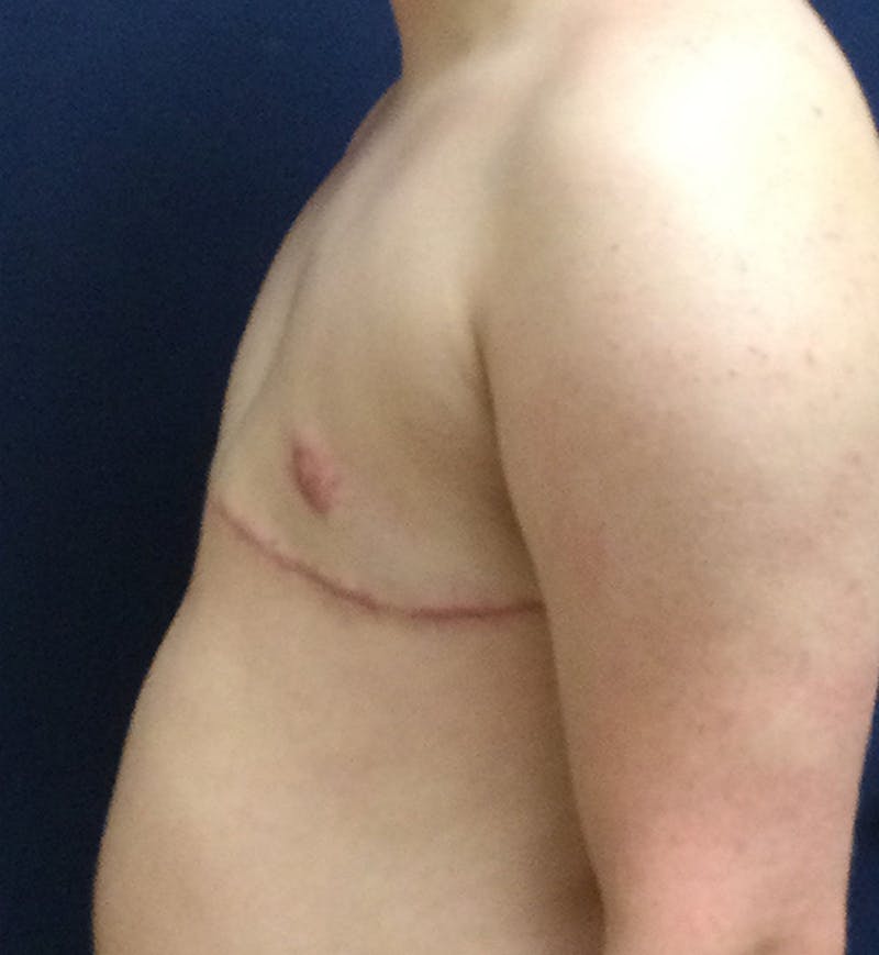 Masculinizing Surgery Before & After Gallery - Patient 333757 - Image 6