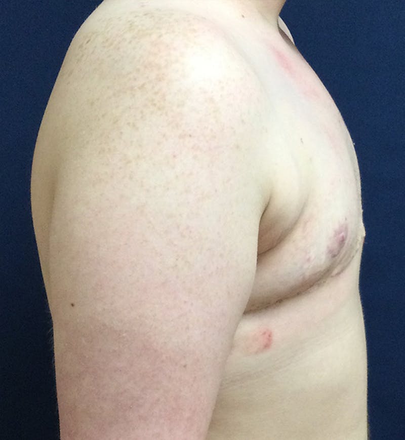 Masculinizing Surgery Before & After Gallery - Patient 333392 - Image 4