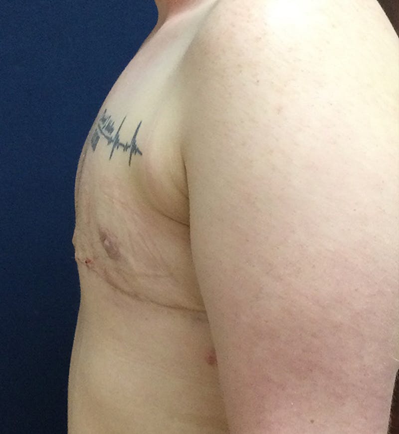 Masculinizing Surgery Before & After Gallery - Patient 333392 - Image 6