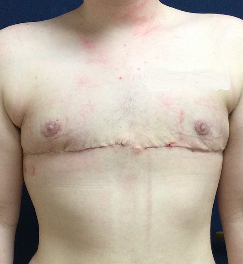 Masculinizing Surgery Before & After Gallery - Patient 333392 - Image 2