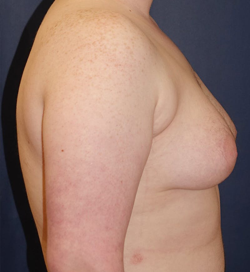 Masculinizing Surgery Before & After Gallery - Patient 333392 - Image 3