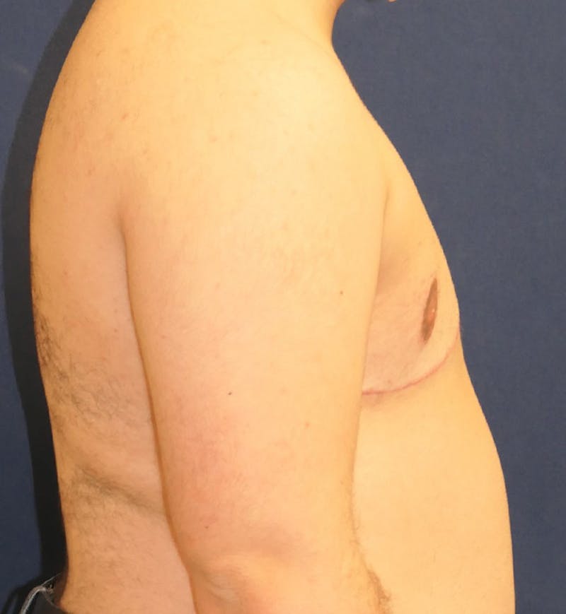 Masculinizing Surgery Before & After Gallery - Patient 392263 - Image 4