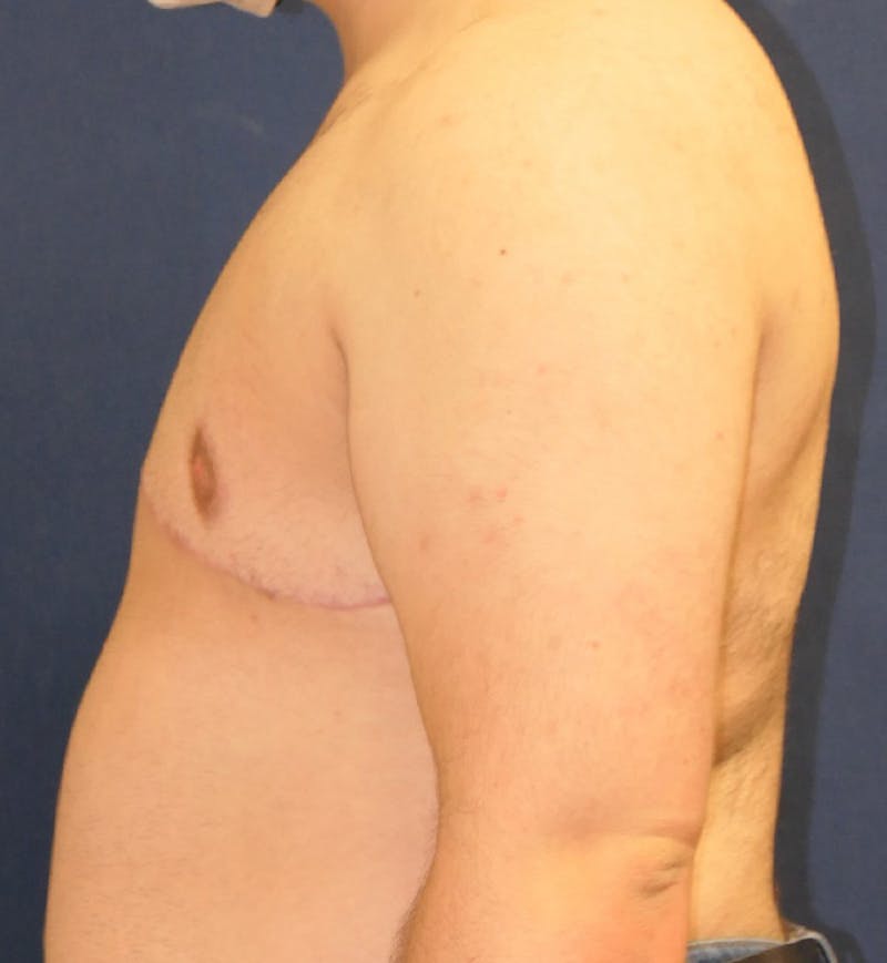Masculinizing Surgery Before & After Gallery - Patient 392263 - Image 6