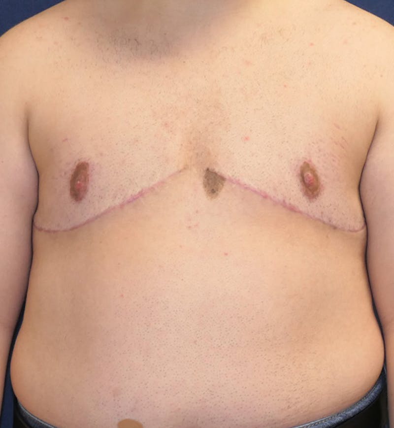 Masculinizing Surgery Before & After Gallery - Patient 392263 - Image 2
