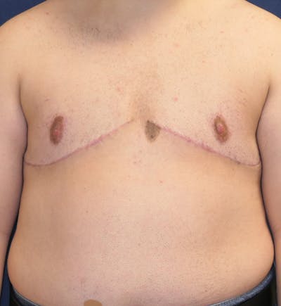 Masculinizing Surgery Before & After Gallery - Patient 392263 - Image 2