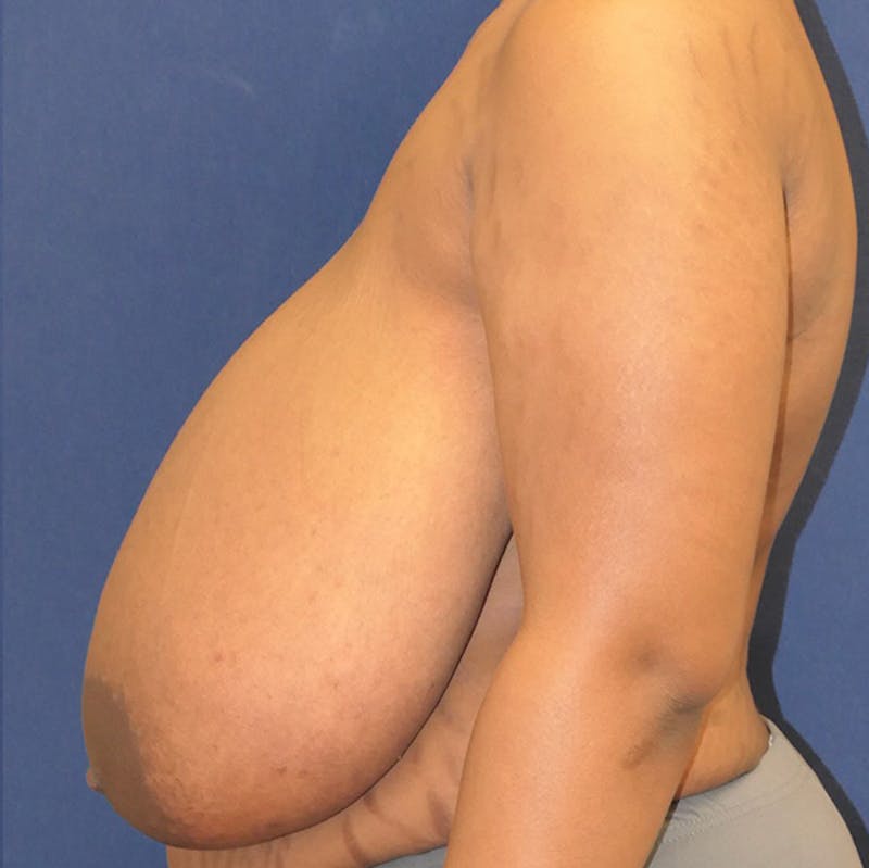 Breast Reduction Before & After Gallery - Patient 261590 - Image 9