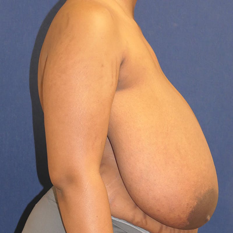 Breast Reduction Before & After Gallery - Patient 261590 - Image 5