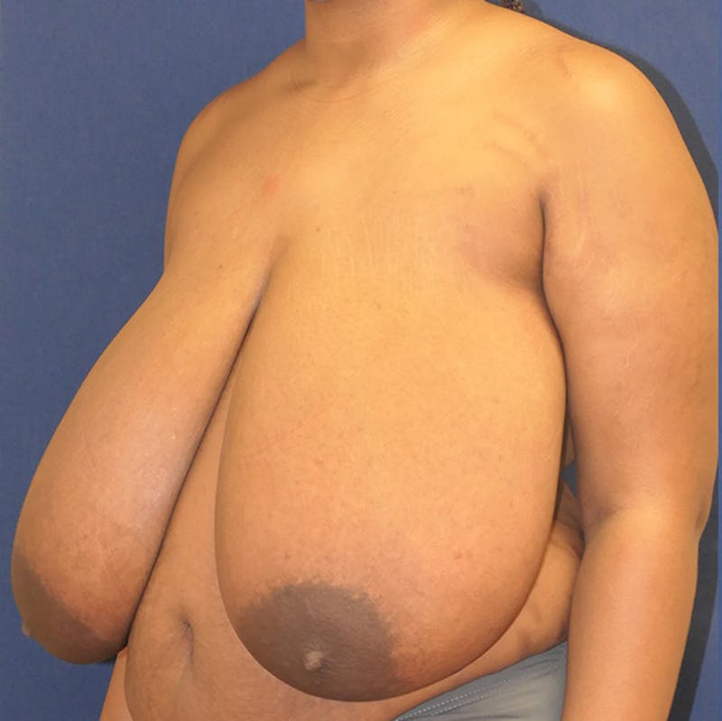 Breast Reduction Before & After Gallery - Patient 261590 - Image 7