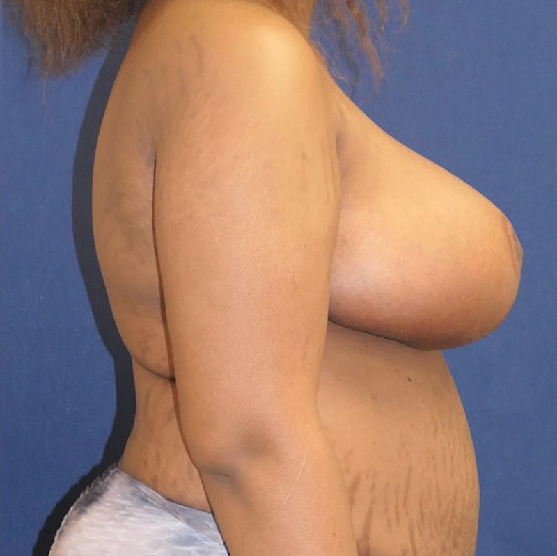 Breast Reduction Before & After Gallery - Patient 261590 - Image 6