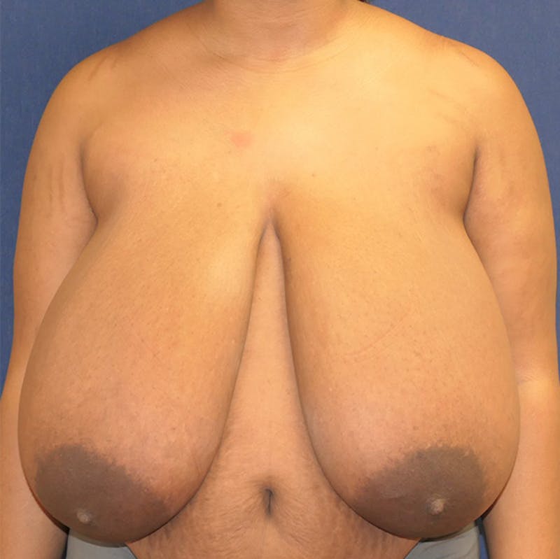Breast Reduction Before & After Gallery - Patient 261590 - Image 1
