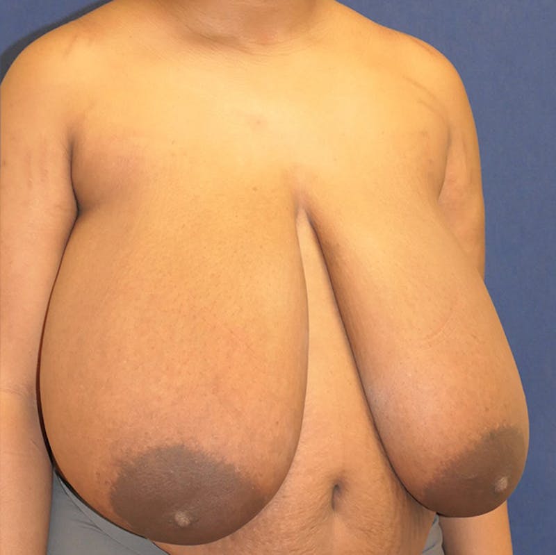 Breast Reduction Before & After Gallery - Patient 261590 - Image 3