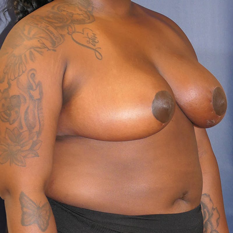Breast Reduction Before & After Gallery - Patient 844823 - Image 4