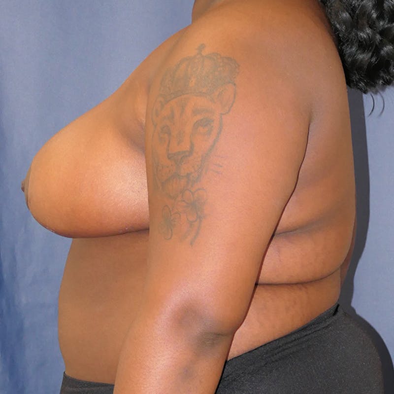 Breast Reduction Before & After Gallery - Patient 844823 - Image 10