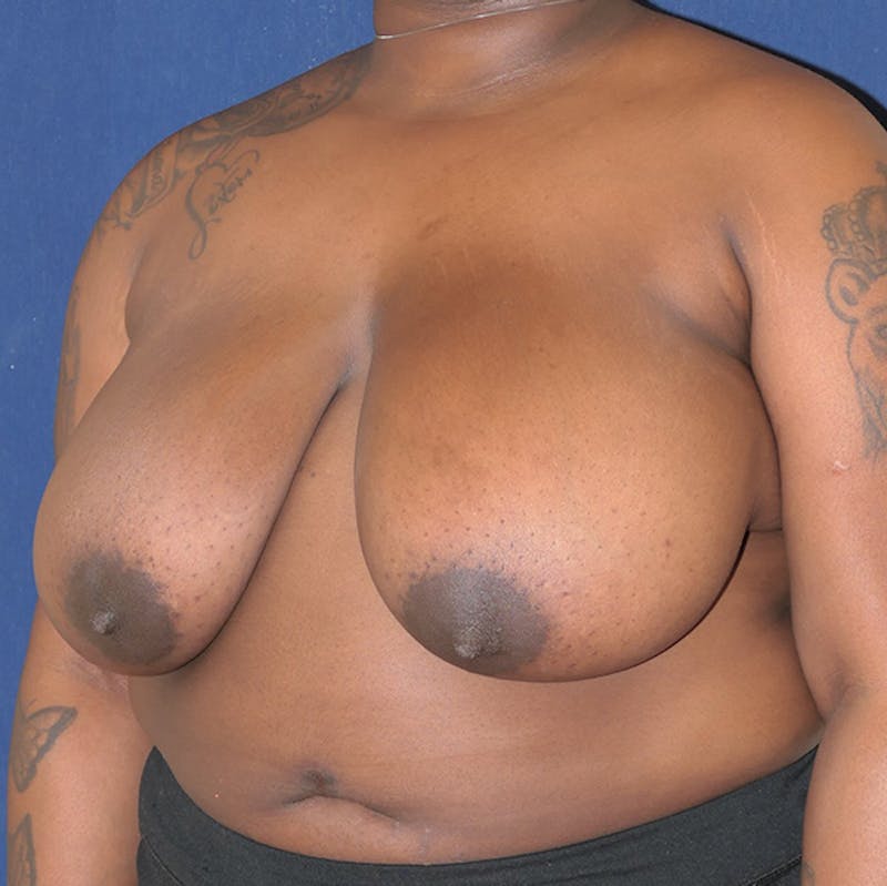 Breast Reduction Before & After Gallery - Patient 844823 - Image 7