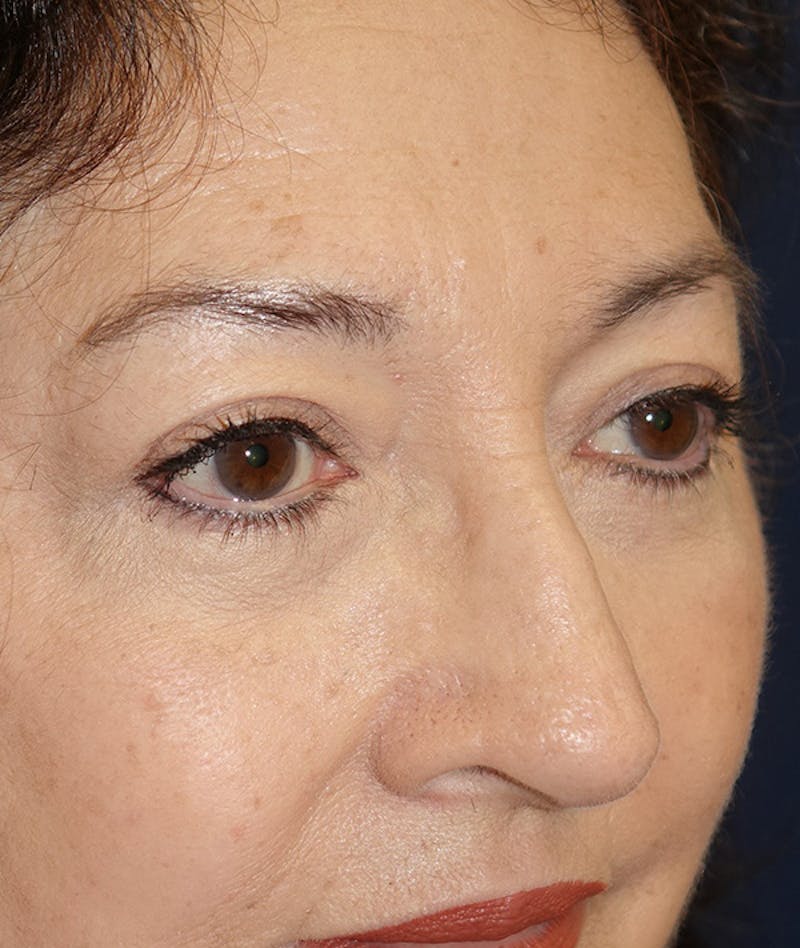 Eyelid Lift (Blepharoplasty) Before & After Gallery - Patient 263584 - Image 4