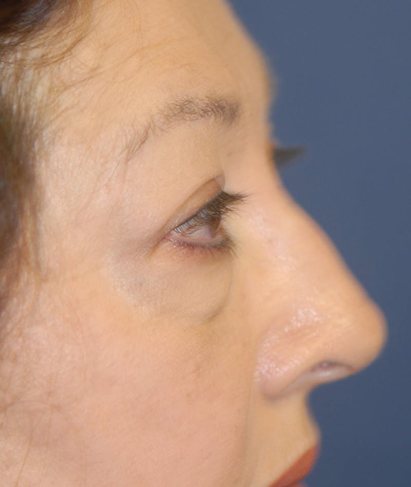 Eyelid Lift (Blepharoplasty) Before & After Gallery - Patient 263584 - Image 5
