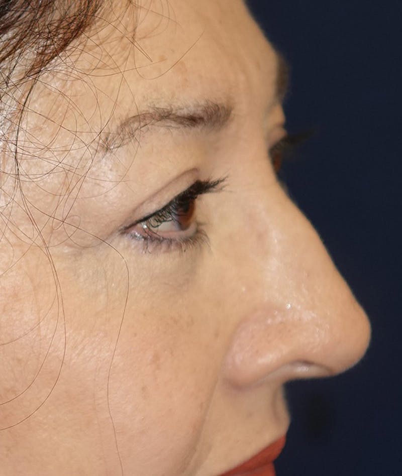 Eyelid Lift (Blepharoplasty) Before & After Gallery - Patient 263584 - Image 6