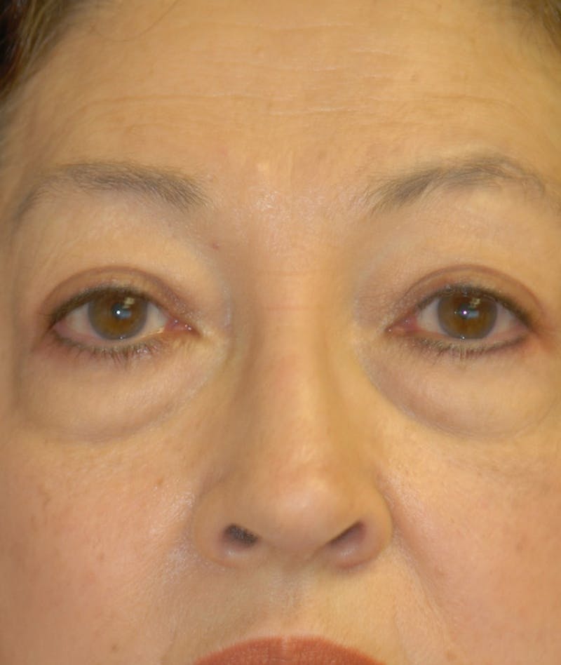 Eyelid Lift (Blepharoplasty) Before & After Gallery - Patient 263584 - Image 1
