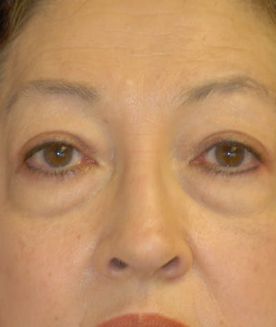 Eyelid Lift (Blepharoplasty) Before & After Gallery - Patient 263584 - Image 1
