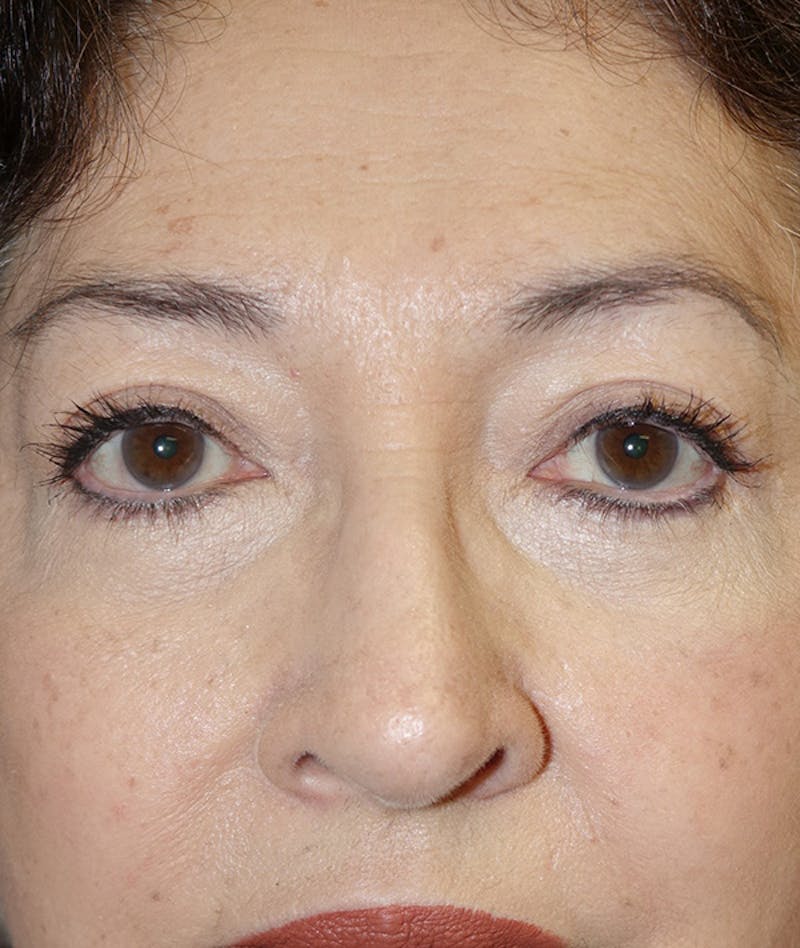 Eyelid Lift (Blepharoplasty) Before & After Gallery - Patient 263584 - Image 2
