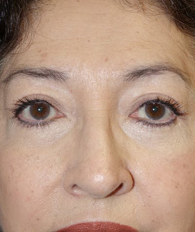 Eyelid Lift (Blepharoplasty) Before & After Gallery - Patient 263584 - Image 2