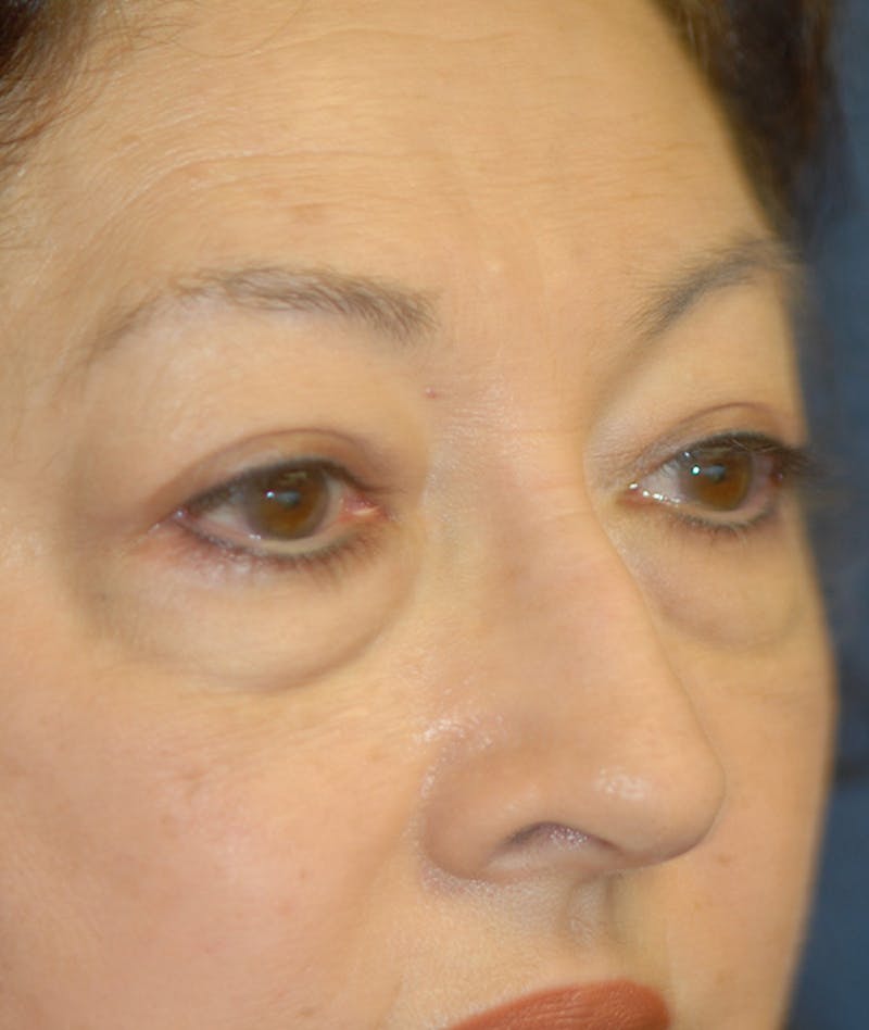 Eyelid Lift (Blepharoplasty) Before & After Gallery - Patient 263584 - Image 3