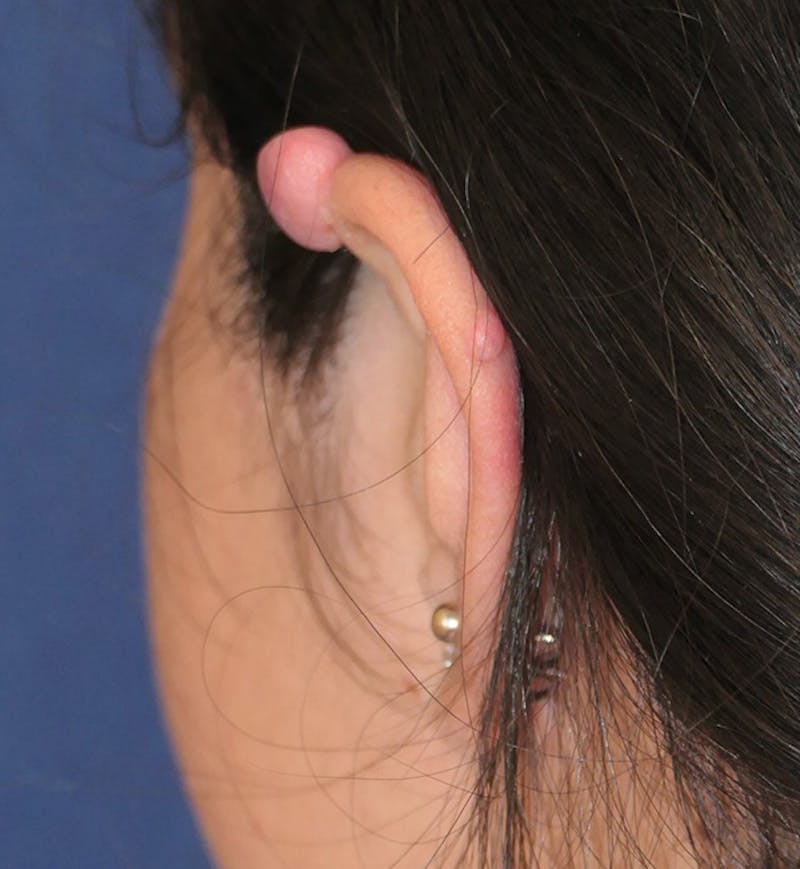 Miscellaneous Before & After Gallery - Patient 566809 - Image 5