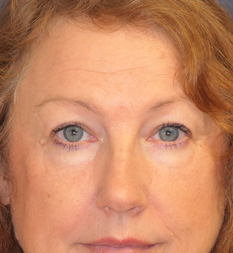 Miscellaneous Before & After Gallery - Patient 724175 - Image 6