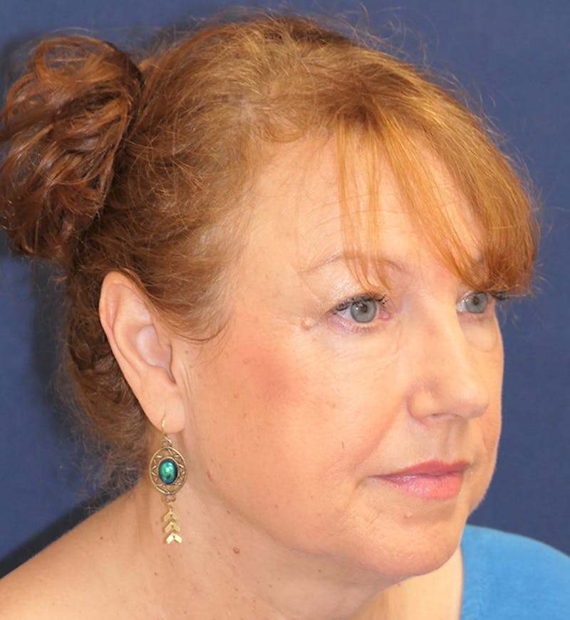 Miscellaneous Before & After Gallery - Patient 724175 - Image 4