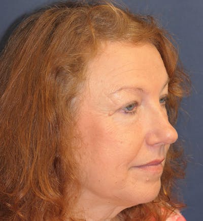 Miscellaneous Before & After Gallery - Patient 724175 - Image 2