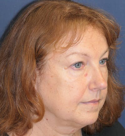 Miscellaneous Before & After Gallery - Patient 724175 - Image 1