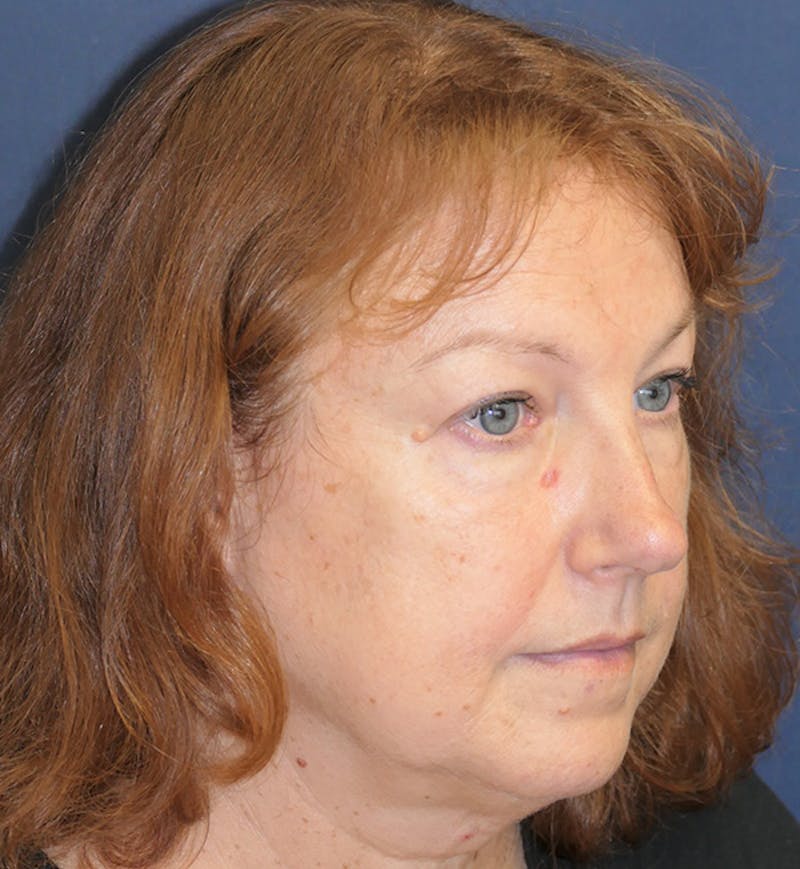 Miscellaneous Before & After Gallery - Patient 724175 - Image 1