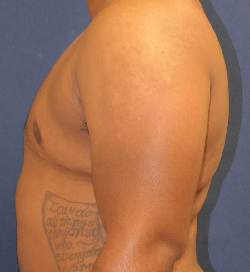 Masculinizing Surgery Before & After Gallery - Patient 396529 - Image 6