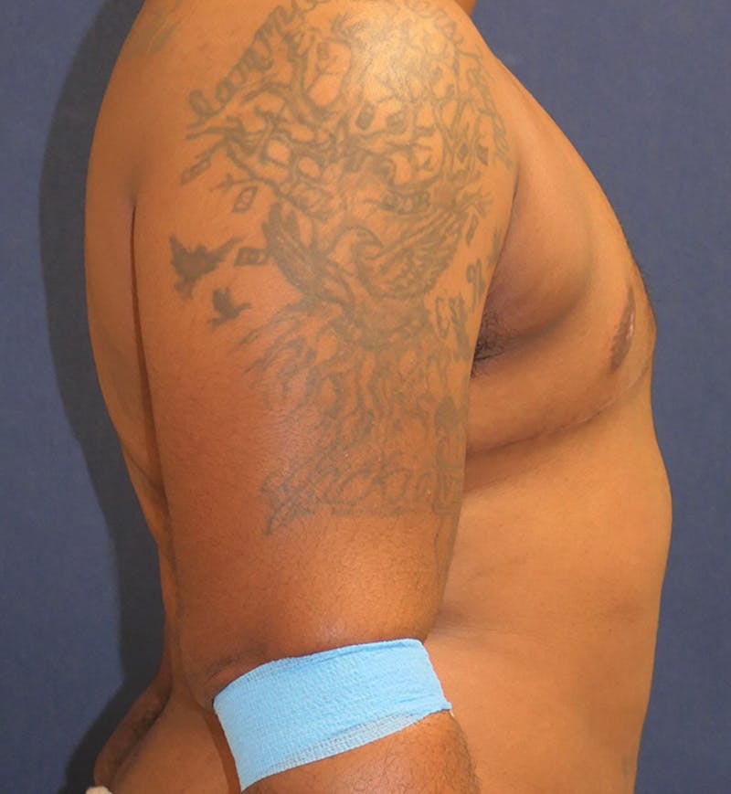 Masculinizing Surgery Before & After Gallery - Patient 396529 - Image 4