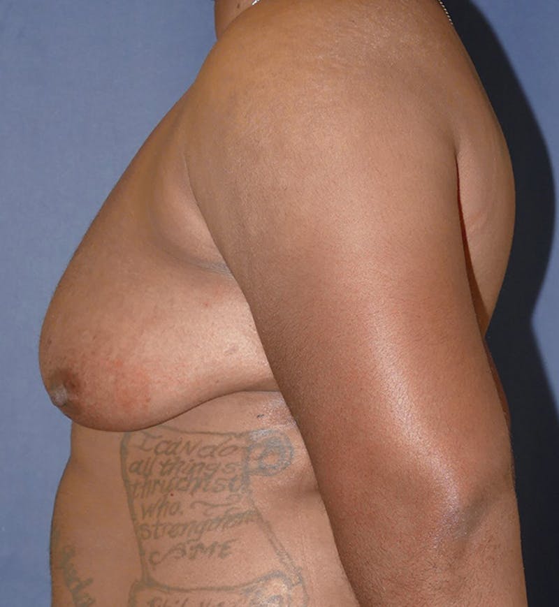 Masculinizing Surgery Before & After Gallery - Patient 396529 - Image 5
