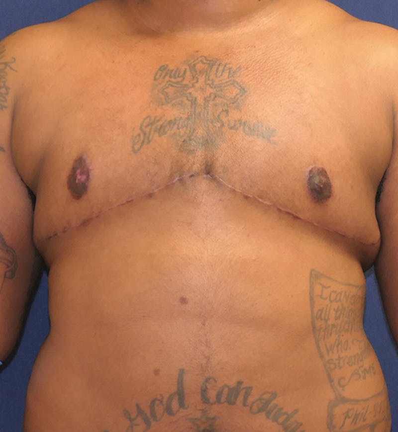 Masculinizing Surgery Before & After Gallery - Patient 396529 - Image 2