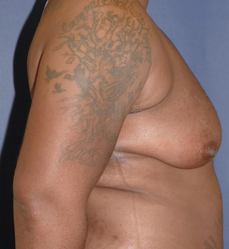 Masculinizing Surgery Before & After Gallery - Patient 396529 - Image 3