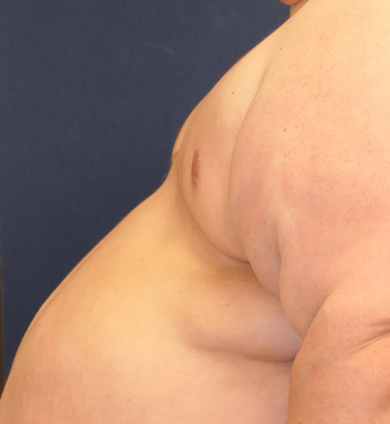 Masculinizing Surgery Before & After Gallery - Patient 691923 - Image 6
