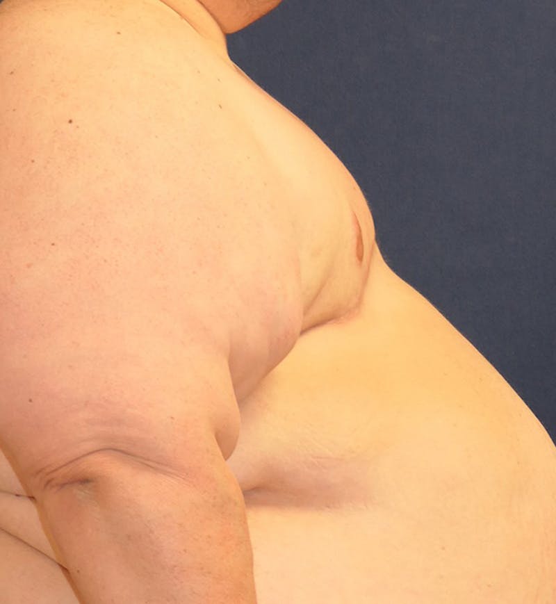 Masculinizing Surgery Before & After Gallery - Patient 691923 - Image 4