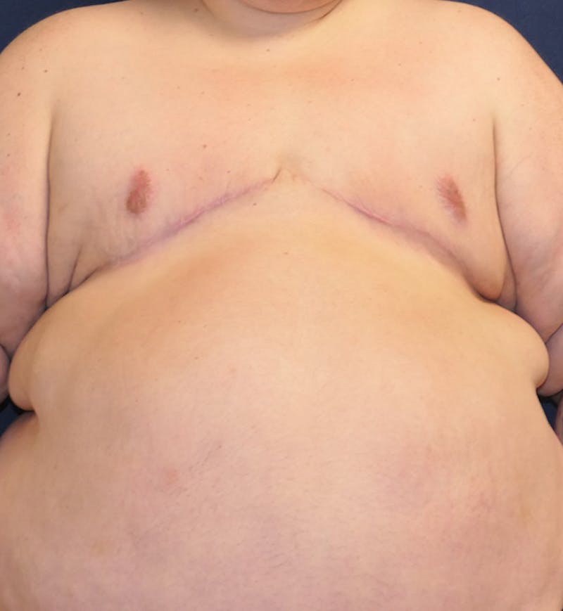 Masculinizing Surgery Before & After Gallery - Patient 691923 - Image 2