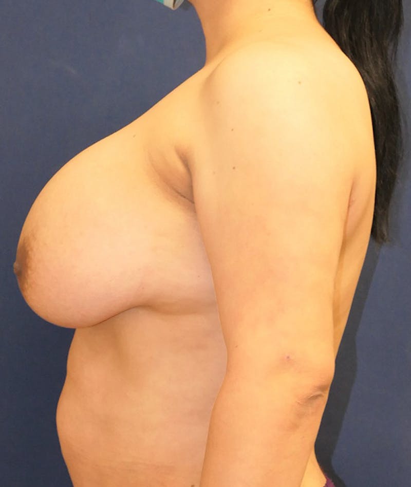 Breast Augmentation Before & After Gallery - Patient 120101 - Image 10