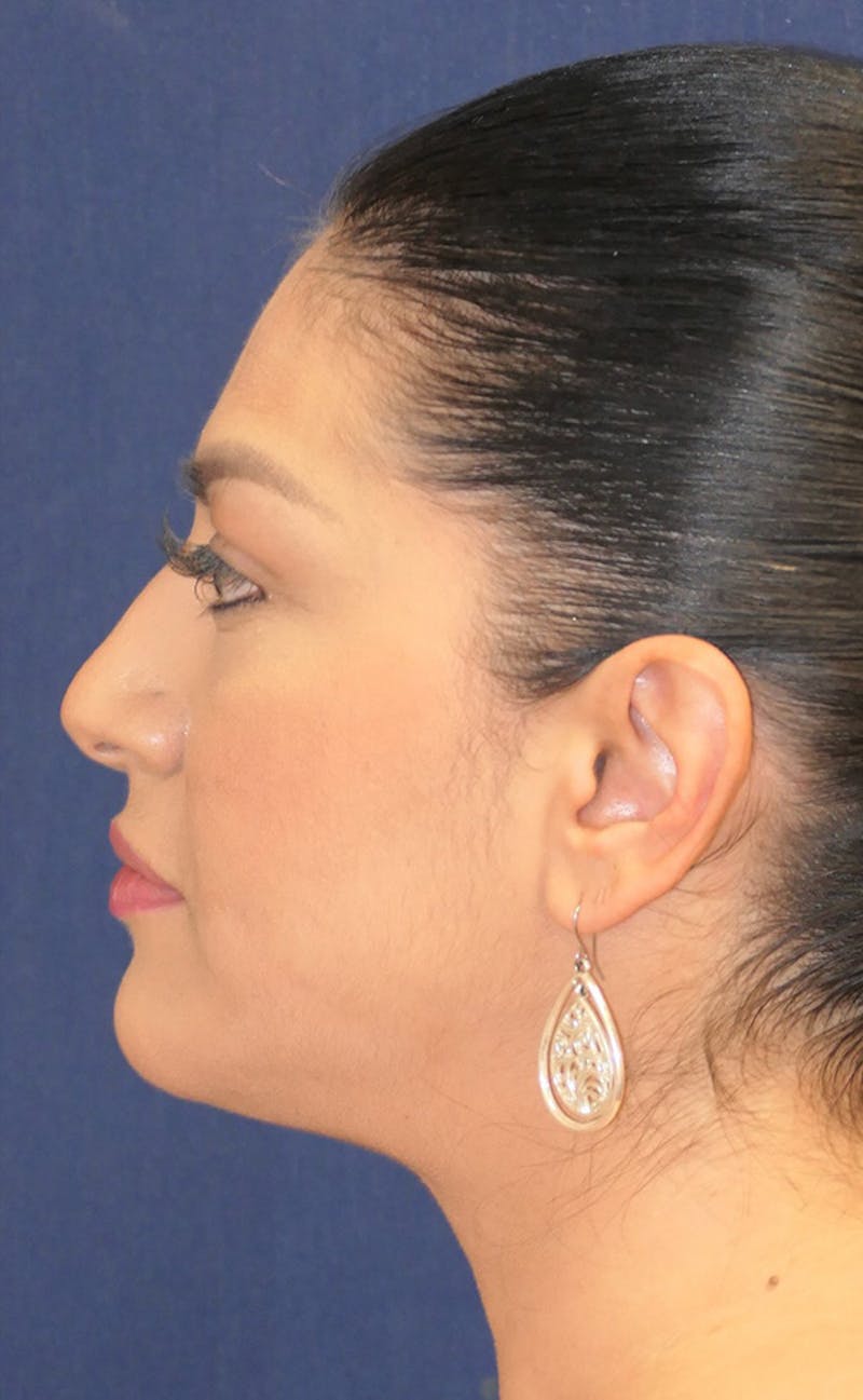Neck Liposuction Before & After Gallery - Patient 241575 - Image 8