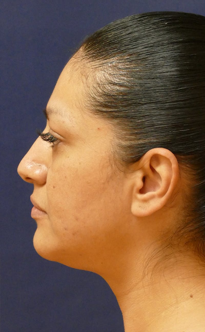 Neck Liposuction Before & After Gallery - Patient 241575 - Image 7