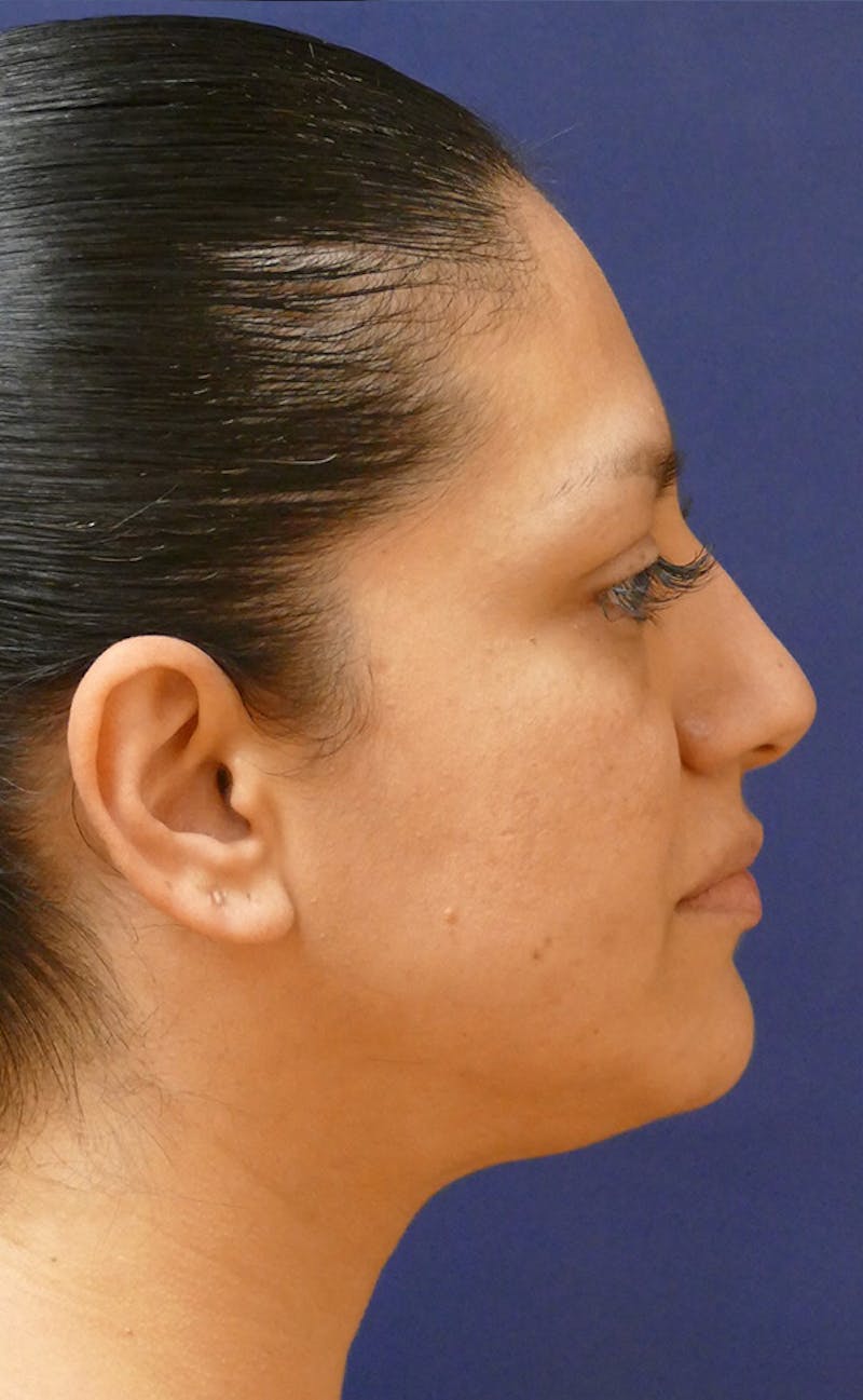Neck Liposuction Before & After Gallery - Patient 241575 - Image 5
