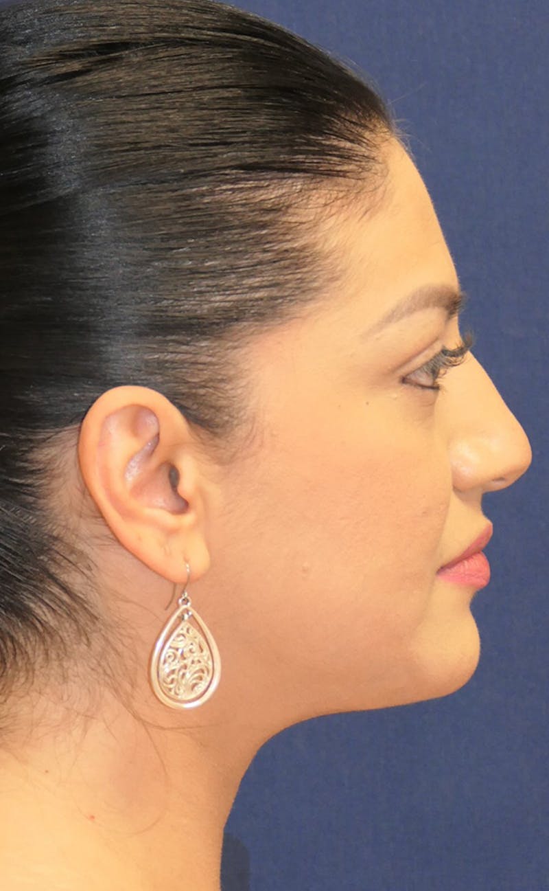 Neck Liposuction Before & After Gallery - Patient 241575 - Image 6