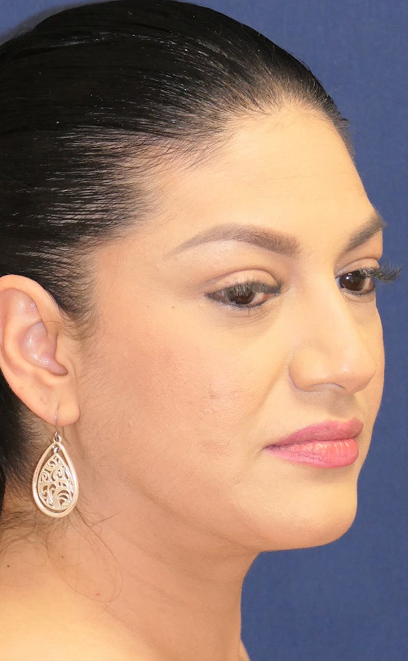 Neck Liposuction Before & After Gallery - Patient 241575 - Image 4