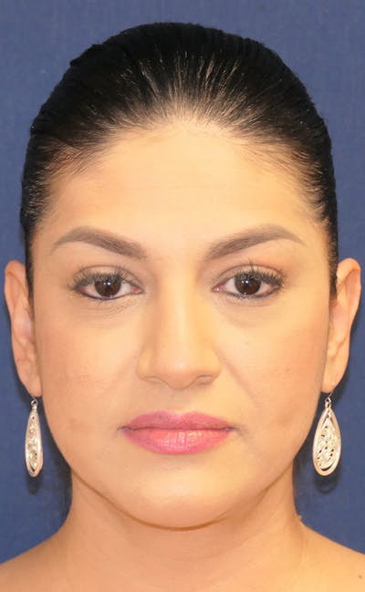 Neck Liposuction Before & After Gallery - Patient 241575 - Image 2