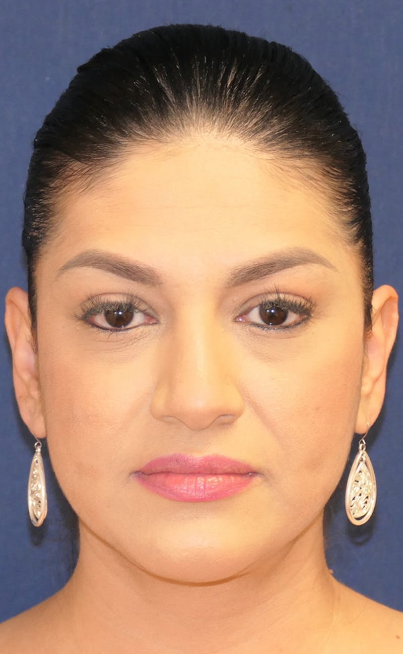 Neck Liposuction Before & After Gallery - Patient 241575 - Image 2