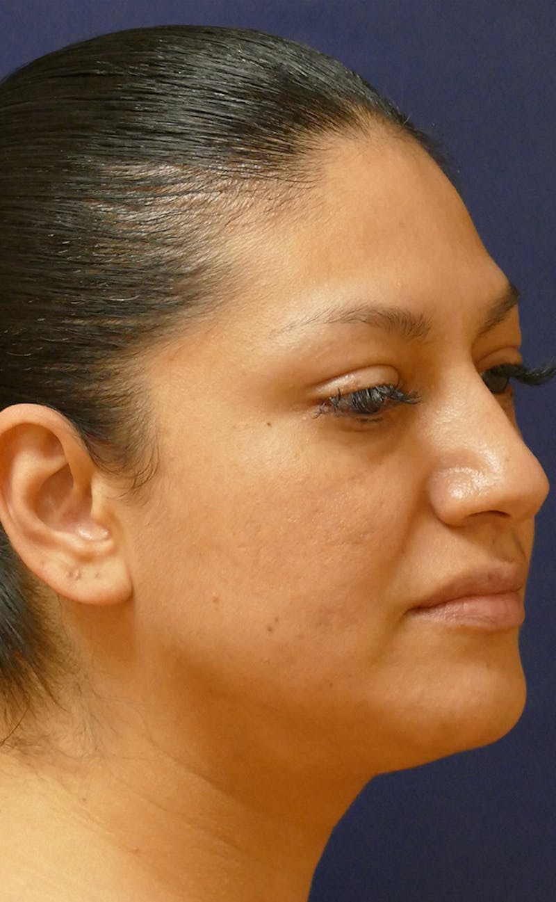 Neck Liposuction Before & After Gallery - Patient 241575 - Image 3